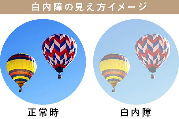 白内障イメージ画像