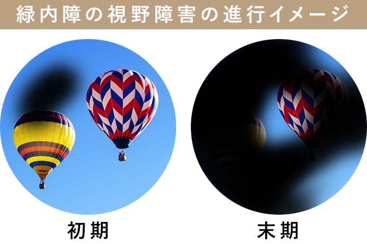 緑内障イメージ画像
